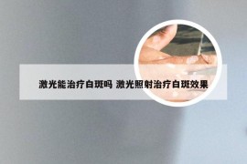 激光能治疗白斑吗 激光照射治疗白斑效果