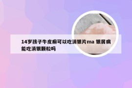 14岁孩子牛皮癣可以吃消银片ma 银屑病能吃消银颗粒吗