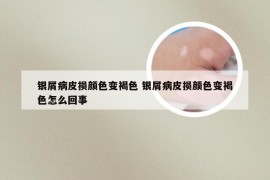 银屑病皮损颜色变褐色 银屑病皮损颜色变褐色怎么回事