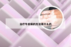 治疗牛皮癣的方法用什么药