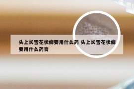 头上长雪花状癣要用什么药 头上长雪花状癣要用什么药膏