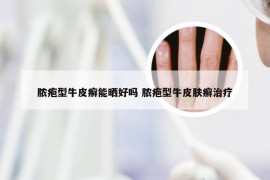 脓疱型牛皮癣能晒好吗 脓疱型牛皮肤癣治疗