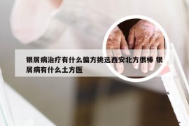 银屑病治疗有什么偏方挑选西安北方很棒 银屑病有什么土方医