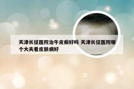 天津长征医院治牛皮癣好吗 天津长征医院哪个大夫看皮肤病好