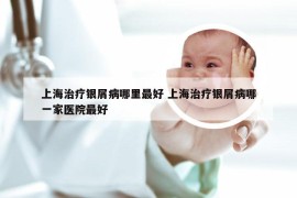 上海治疗银屑病哪里最好 上海治疗银屑病哪一家医院最好