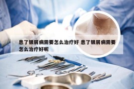 患了银屑病需要怎么治疗好 患了银屑病需要怎么治疗好呢