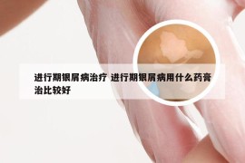 进行期银屑病治疗 进行期银屑病用什么药膏治比较好