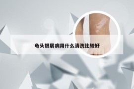 龟头银屑病用什么清洗比较好