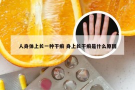 人身体上长一种干癣 身上长干癣是什么原因