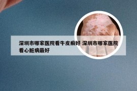 深圳市哪家医院看牛皮癣好 深圳市哪家医院看心脏病最好