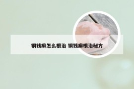 铜钱癣怎么根治 铜钱癣根治秘方