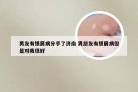 男友有银屑病分手了济南 男朋友有银屑病但是对我很好