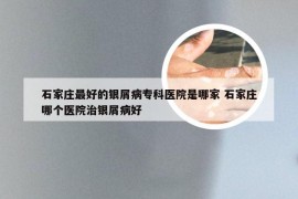 石家庄最好的银屑病专科医院是哪家 石家庄哪个医院治银屑病好