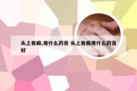 头上有癣,用什么药膏 头上有癣用什么药膏好