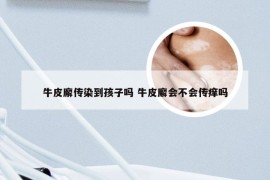 牛皮廨传染到孩子吗 牛皮廨会不会传痒吗