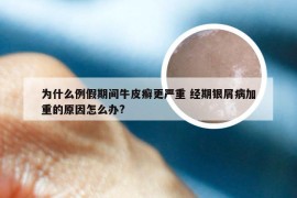 为什么例假期间牛皮癣更严重 经期银屑病加重的原因怎么办?