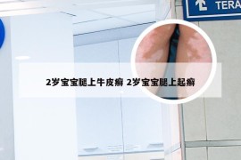 2岁宝宝腿上牛皮癣 2岁宝宝腿上起癣