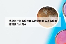 头上长一长长癣吃什么药能根治 头上长癣的原因用什么药水