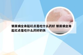 银屑病全身起红点是吃什么药好 银屑病全身起红点是吃什么药好的快