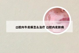 口腔内牛皮癣怎么治疗 口腔内皮肤病