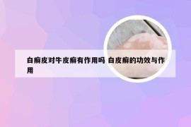 白癣皮对牛皮癣有作用吗 白皮癣的功效与作用