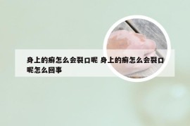 身上的癣怎么会裂口呢 身上的癣怎么会裂口呢怎么回事