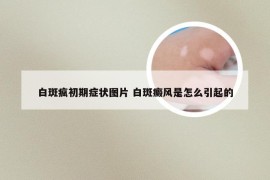 白斑疯初期症状图片 白斑癜风是怎么引起的