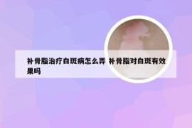 补骨脂治疗白斑病怎么弄 补骨脂对白斑有效果吗