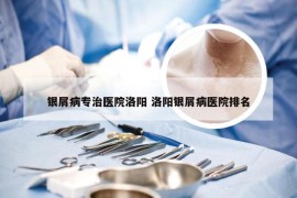 银屑病专治医院洛阳 洛阳银屑病医院排名