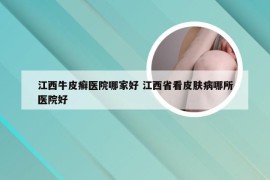 江西牛皮癣医院哪家好 江西省看皮肤病哪所医院好