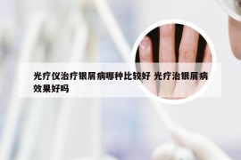 光疗仪治疗银屑病哪种比较好 光疗治银屑病效果好吗