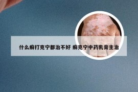 什么癣打克宁都治不好 癣克宁中药乳膏主治