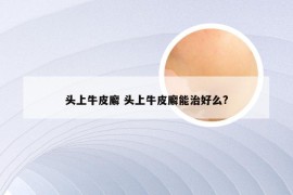 头上牛皮廨 头上牛皮廨能治好么?