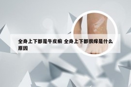 全身上下都是牛皮癣 全身上下都很痒是什么原因