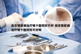 南京银屑病治疗哪个医院好不好 南京银屑病治疗哪个医院好不好呢