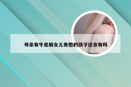 母亲有牛皮癣女儿有他的孩子还会有吗