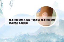 身上皮肤容易长癣是什么原因 身上皮肤容易长癣是什么原因呢