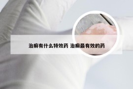 治癣有什么特效药 治癣最有效的药