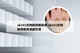 ak101生物制剂银屑病 ak101生物制剂银屑病副作用