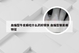 血燥型牛皮癣吃什么药好得快 血燥型银屑病特征