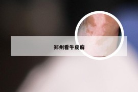 郑州看牛皮癣