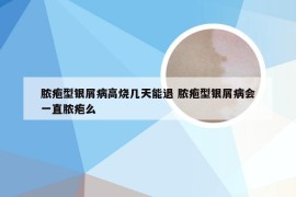 脓疱型银屑病高烧几天能退 脓疱型银屑病会一直脓疱么