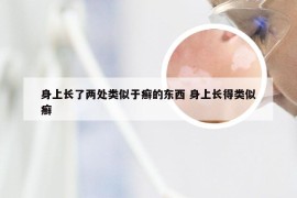 身上长了两处类似于癣的东西 身上长得类似癣