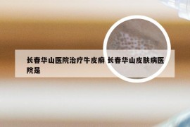 长春华山医院治疗牛皮癣 长春华山皮肤病医院是