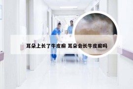 耳朵上长了牛皮癣 耳朵会长牛皮廨吗