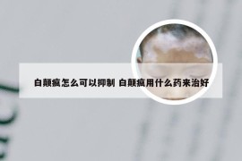 白颠疯怎么可以抑制 白颠疯用什么药来治好