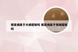 银屑病属于大病报销吗 银屑病属于慢病报销吗