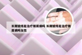 长期锻炼能治疗银屑病吗 长期锻炼能治疗银屑病吗女性