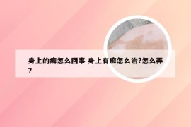 身上的癣怎么回事 身上有癣怎么治?怎么弄?