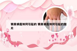 银屑病是如何引起的 银屑病是如何引起的图片